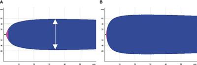 Association between loss of hypercoagulable phenotype, clinical features and complement pathway consumption in COVID-19